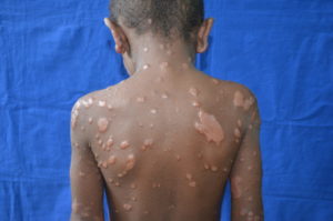 leprosy lesions on a child's back